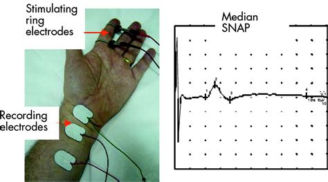 lumbar foot drop but normal nerve conduction test|sensory nerve conduction study.